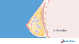 Afbeelding Phyllodestumor