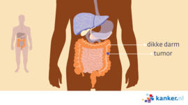 Afbeelding Dikke darm met tumor
