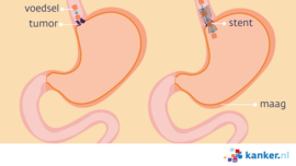 Afbeelding Een stent bij maagkanker