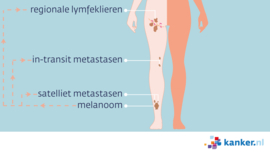 Afbeelding Uitzaaiingen van een melanoom op het been