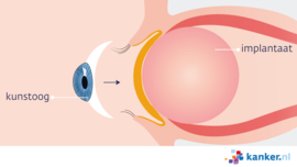 Afbeelding Implantaat in oogkas na verwijderen oog