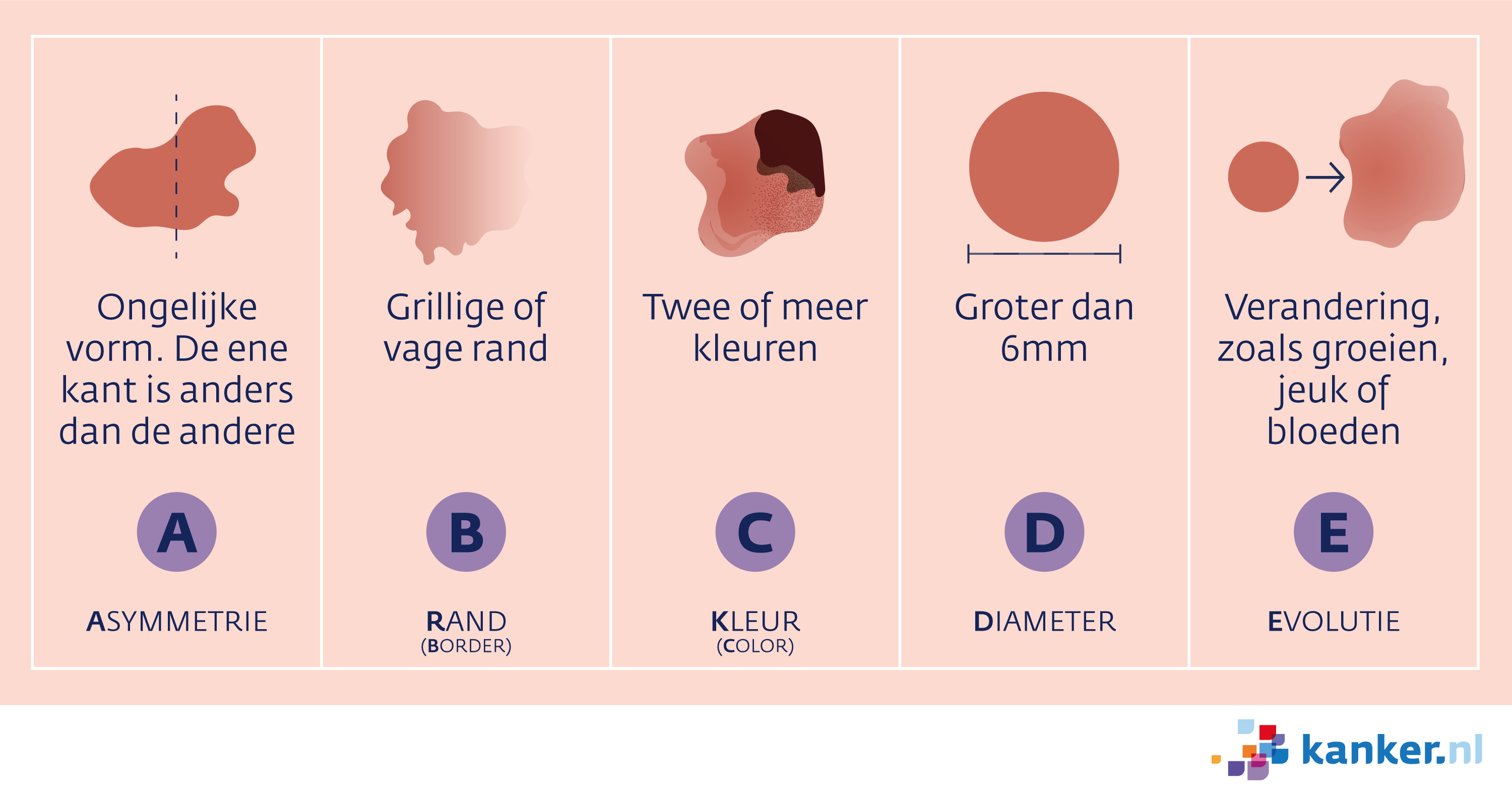 Afbeelding Herken een melanoom met de ABCDE-regel