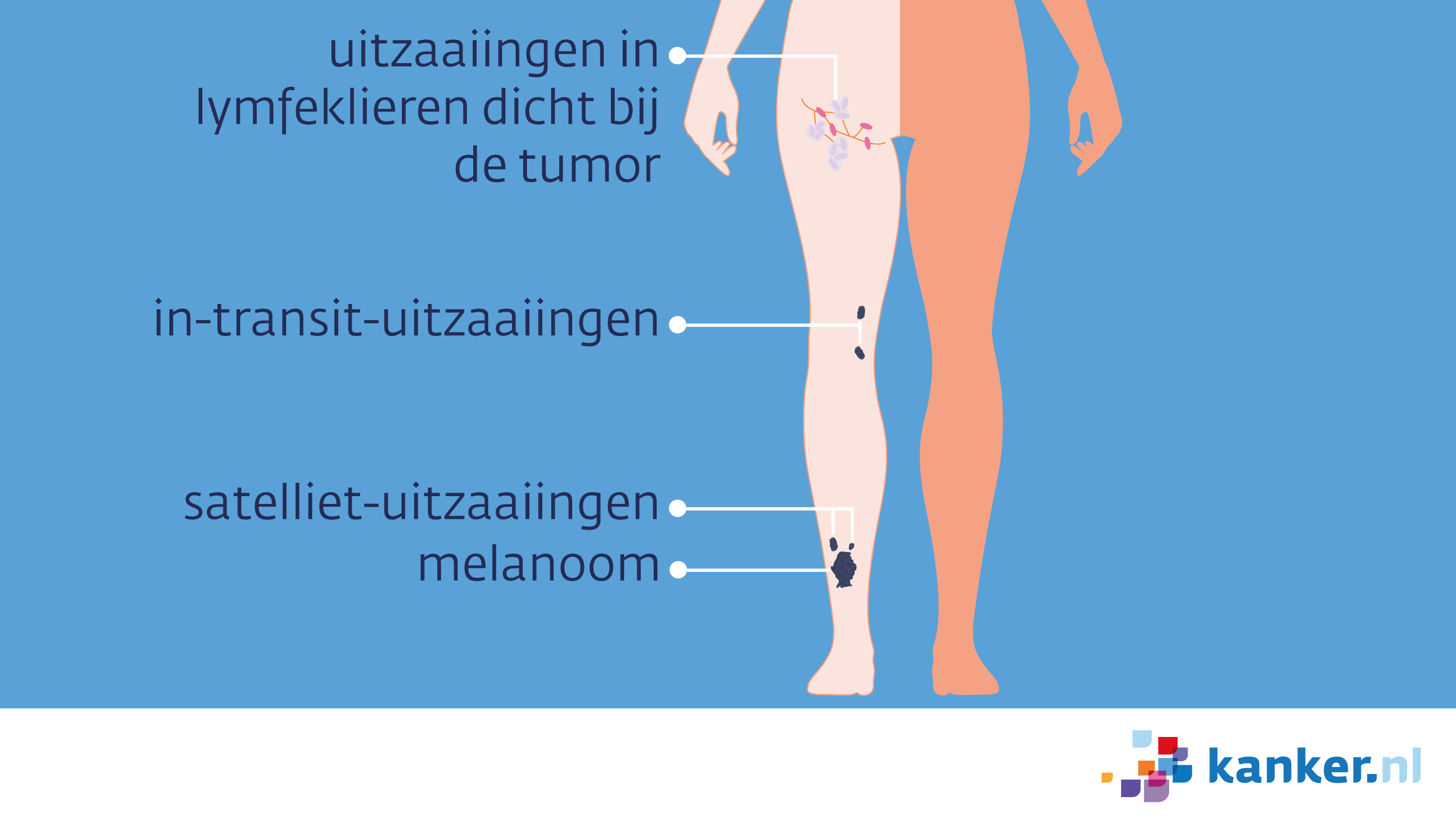 Afbeelding Uitzaaiingen van een melanoom op het been