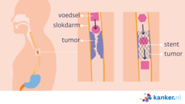 Afbeelding Een stent bij slokdarmkanker