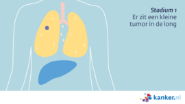 Afbeelding Longkanker stadium 1
