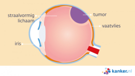 Afbeelding Oogmelanoom (uveamelanoom)