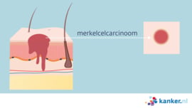 Merkelcelcarcinoom