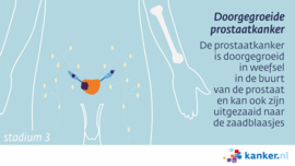 Afbeelding Doorgegroeide prostaatkanker (stadium 3)
