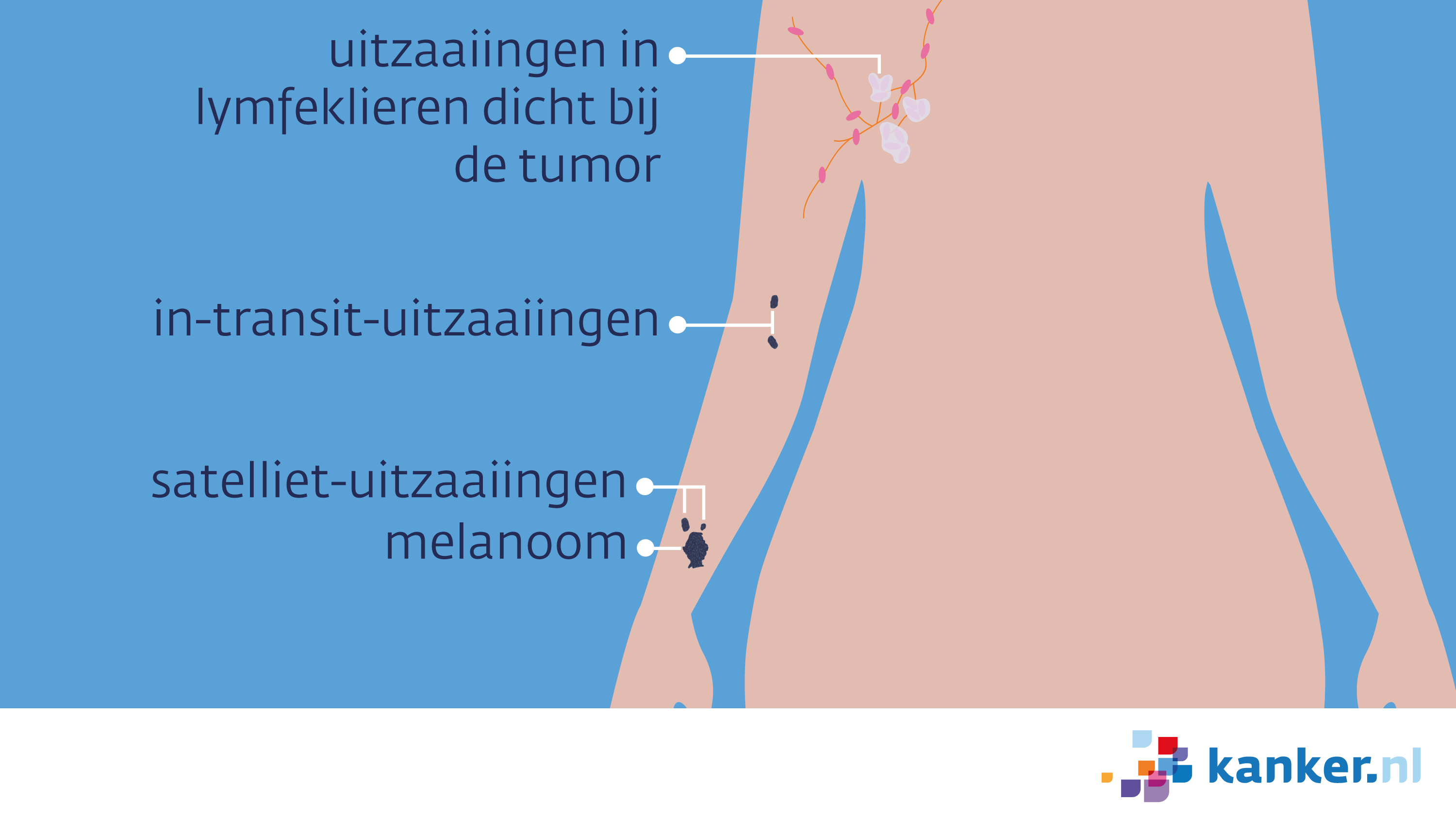 Afbeelding Uitzaaiingen van een melanoom op de arm