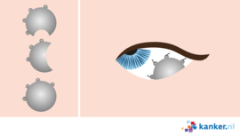 Afbeelding Rutheniumbestraling bij oogmelanoom
