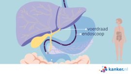 Afbeelding ERCP-onderzoek
