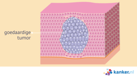 Goedaardige en kwaadaardige tumor