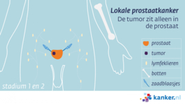 Afbeelding Lokale prostaatkanker (stadium 1 en 2)