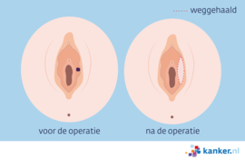 Afbeelding Schaamlipkanker operatie schaamlipkanker