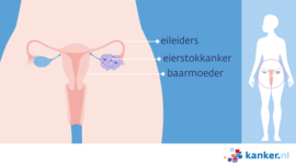 Afbeelding Eierstokkanker eierstok met tumor