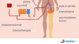 Afbeelding Voorbeeld perfusiebehandeling been