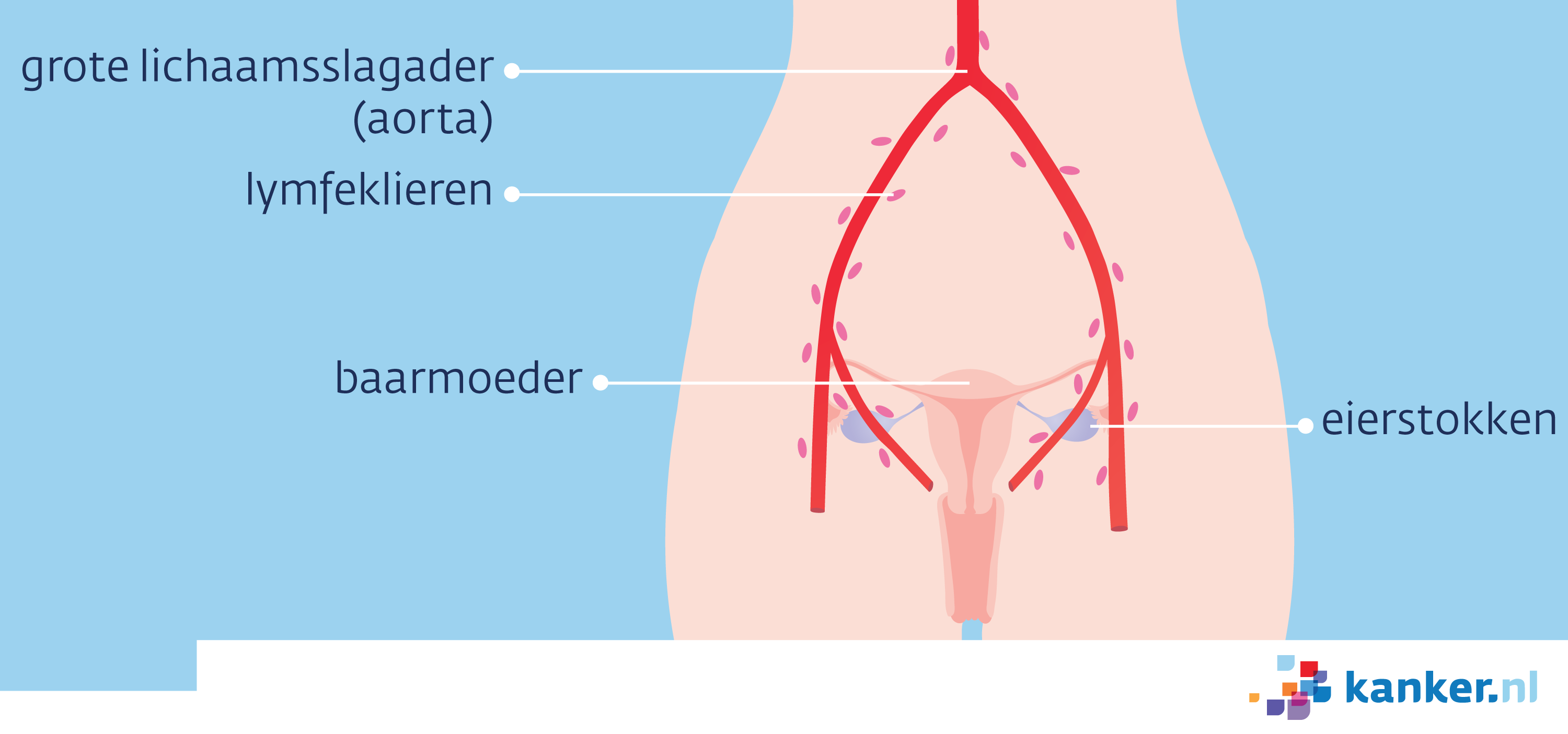 Afbeelding Uitzaaiingen in het bekken en langs de aorta