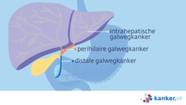 Afbeelding Soorten galwegkanker