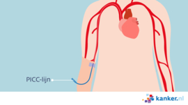 Afbeelding Chemotherapie - PICC-lijn