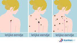 Afbeelding Herken een melanoom: let op het ‘lelijke eendje’ tussen je moedervlekken