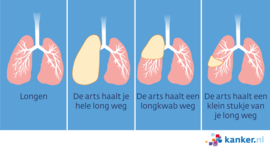 Afbeelding Verschillende manieren van een longoperatie