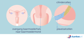 Afbeelding Overgangsgebied baarmoederhals