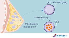 Afbeelding DCIS - ductaal carcinoma in situ