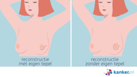 Afbeelding Litteken na borstamputatie met reconstructie