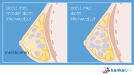 Afbeelding Dicht borstklierweefsel