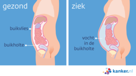Afbeelding Vocht in de buikholte (ascites)
