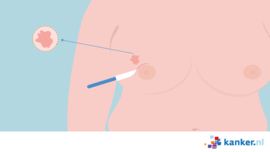 Afbeelding Borstsparende operatie
