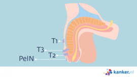 Afbeelding Stadiumindeling peniskanker