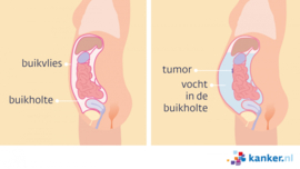 Afbeelding Vocht in de buikholte - Ascites