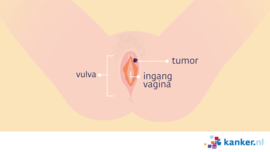 Afbeelding Schaamlipkanker vulva met tumor