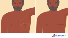 Litteken na borstamputatie zonder reconstructie