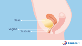 Afbeelding De plasbuis bij de vrouw
